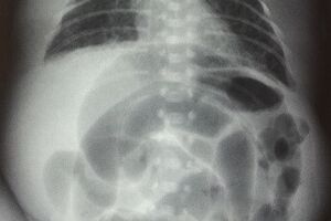 Некротический энтероколит новорожденных: причины возникновения и основные симптомы, способы лечения заболевания