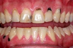 Некроз твердых тканей зуба: причины возникновения и основные симптомы, способы лечения заболевания