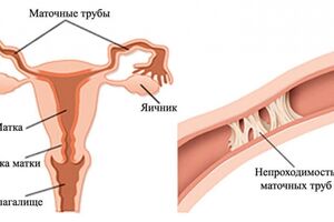 Непроходимость маточных труб: причины возникновения и основные симптомы, способы лечения заболевания
