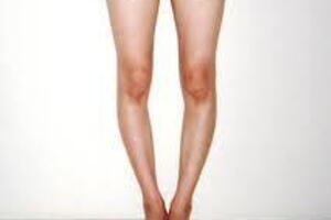 О-образные ноги: причини виникнення та основні симптоми, способи лікування захворювання