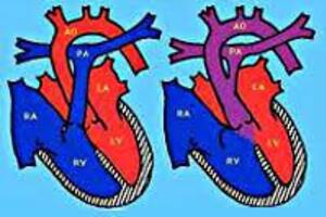 Общий артериальный ствол: причины возникновения и основные симптомы, способы лечения заболевания