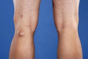 Киста коленного сустава: причини виникнення та основні симптоми, способи лікування захворювання