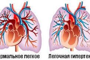 Легочная гипертензия новорожденных: причины возникновения и основные симптомы, способы лечения заболевания