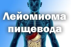 Лейомиома пищевода: причини виникнення та основні симптоми, способи лікування захворювання
