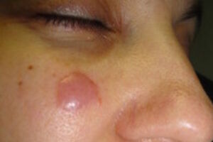 Лимфоцитома кожи: причини виникнення та основні симптоми, способи лікування захворювання