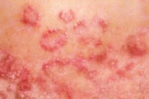 Лимфома кожи: причини виникнення та основні симптоми, способи лікування захворювання