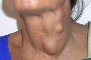 Лимфома щитовидной железы: причини виникнення та основні симптоми, способи лікування захворювання