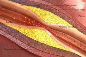 Окклюзия подключичной артерии: причины возникновения и основные симптомы, способы лечения заболевания