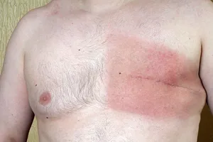 Рак молочной железы у мужчин: причини виникнення та основні симптоми, способи лікування захворювання