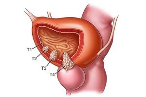 Рак мочевого пузыря: причины возникновения и основные симптомы, способы лечения заболевания