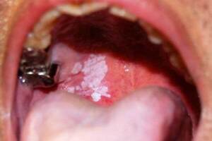 Рак полости рта: причини виникнення та основні симптоми, способи лікування захворювання