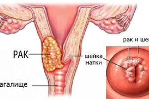 Рак шейки матки при беременности: причины возникновения и основные симптомы, способы лечения заболевания