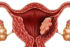 Рак тела матки: причини виникнення та основні симптоми, способи лікування захворювання