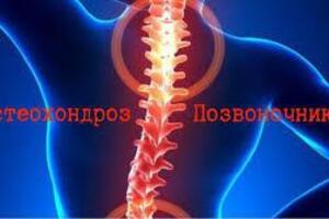 Остеохондроз позвоночника
