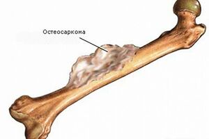 Остеосаркома: причины возникновения и основные симптомы, способы лечения заболевания