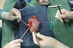 Осложнения трансплантации почки: причини виникнення та основні симптоми, способи лікування захворювання