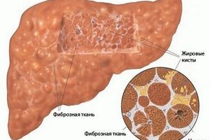 Реактивный гепатит: причины возникновения и основные симптомы, способы лечения заболевания