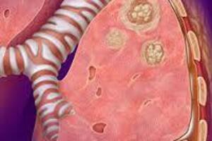 Осумкованный плеврит: причины возникновения и основные симптомы, способы лечения заболевания