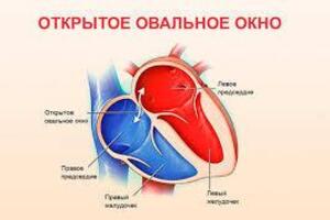 Открытое овальное окно: причины возникновения и основные симптомы, способы лечения заболевания