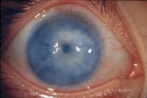 Открытоугольная глаукома: причини виникнення та основні симптоми, способи лікування захворювання