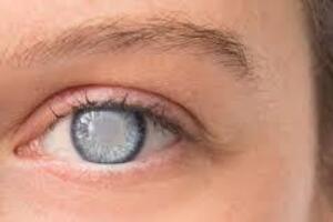 Открытоугольная ювенильная глаукома: причины возникновения и основные симптомы, способы лечения заболевания