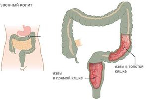 Ректосигмоидит: причини виникнення та основні симптоми, способи лікування захворювання