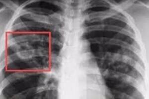Очаговый туберкулез легких: причины возникновения и основные симптомы, способы лечения заболевания
