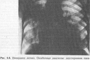 Нокардиоз: причины возникновения и основные симптомы, способы лечения заболевания