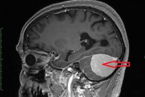 Опухоли мозжечка: причины возникновения и основные симптомы, способы лечения заболевания