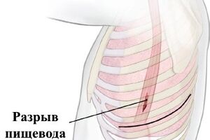 Разрыв пищевода: причины возникновения и основные симптомы, способы лечения заболевания