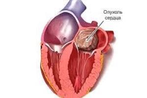 Опухоли сердца: причини виникнення та основні симптоми, способи лікування захворювання