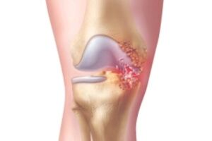 Панартрит: причини виникнення та основні симптоми, способи лікування захворювання