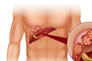 Саркома печени: причины возникновения и основные симптомы, способы лечения заболевания
