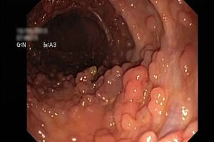 Семейный полипоз толстой кишки: причини виникнення та основні симптоми, способи лікування захворювання