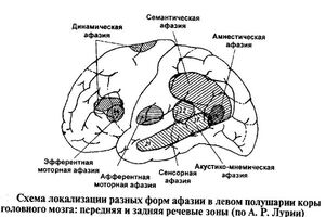 Семантическая афазия: причини виникнення та основні симптоми, способи лікування захворювання