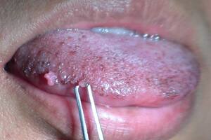 Папилломы полости рта: причины возникновения и основные симптомы, способы лечения заболевания