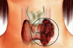 Папиллярный рак щитовидной железы: причины возникновения и основные симптомы, способы лечения заболевания