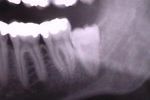 Ретинированный зуб: причины возникновения и основные симптомы, способы лечения заболевания
