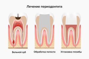 Серозный периодонтит: причини виникнення та основні симптоми, способи лікування захворювання