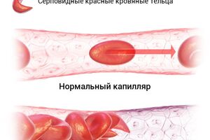 Серповидно-клеточная анемия: причины возникновения и основные симптомы, способы лечения заболевания
