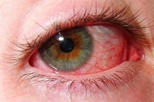 Симпатическая офтальмия: причины возникновения и основные симптомы, способы лечения заболевания