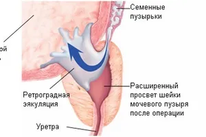 Ретроградная эякуляция: причины возникновения и основные симптомы, способы лечения заболевания