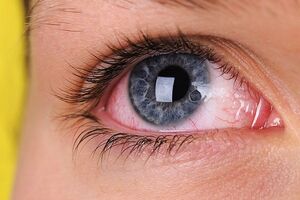 Синдром красного глаза: причины возникновения и основные симптомы, способы лечения заболевания