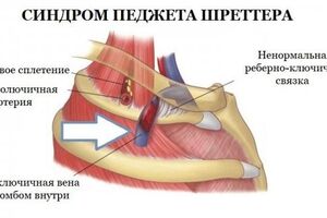 Синдром Педжета-Шреттера: причини виникнення та основні симптоми, способи лікування захворювання