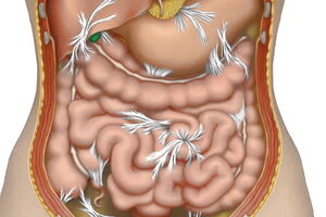 Спаечная болезнь: причини виникнення та основні симптоми, способи лікування захворювання