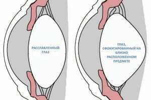 Спазм аккомодации: причини виникнення та основні симптоми, способи лікування захворювання