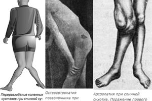 Спинная сухотка: причины возникновения и основные симптомы, способы лечения заболевания