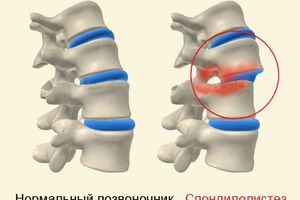 Спондилолистез: причины возникновения и основные симптомы, способы лечения заболевания
