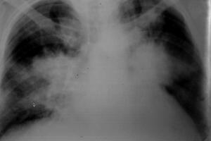 Стафилококковая пневмония: причины возникновения и основные симптомы, способы лечения заболевания