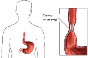 Стеноз пищевода: причины возникновения и основные симптомы, способы лечения заболевания